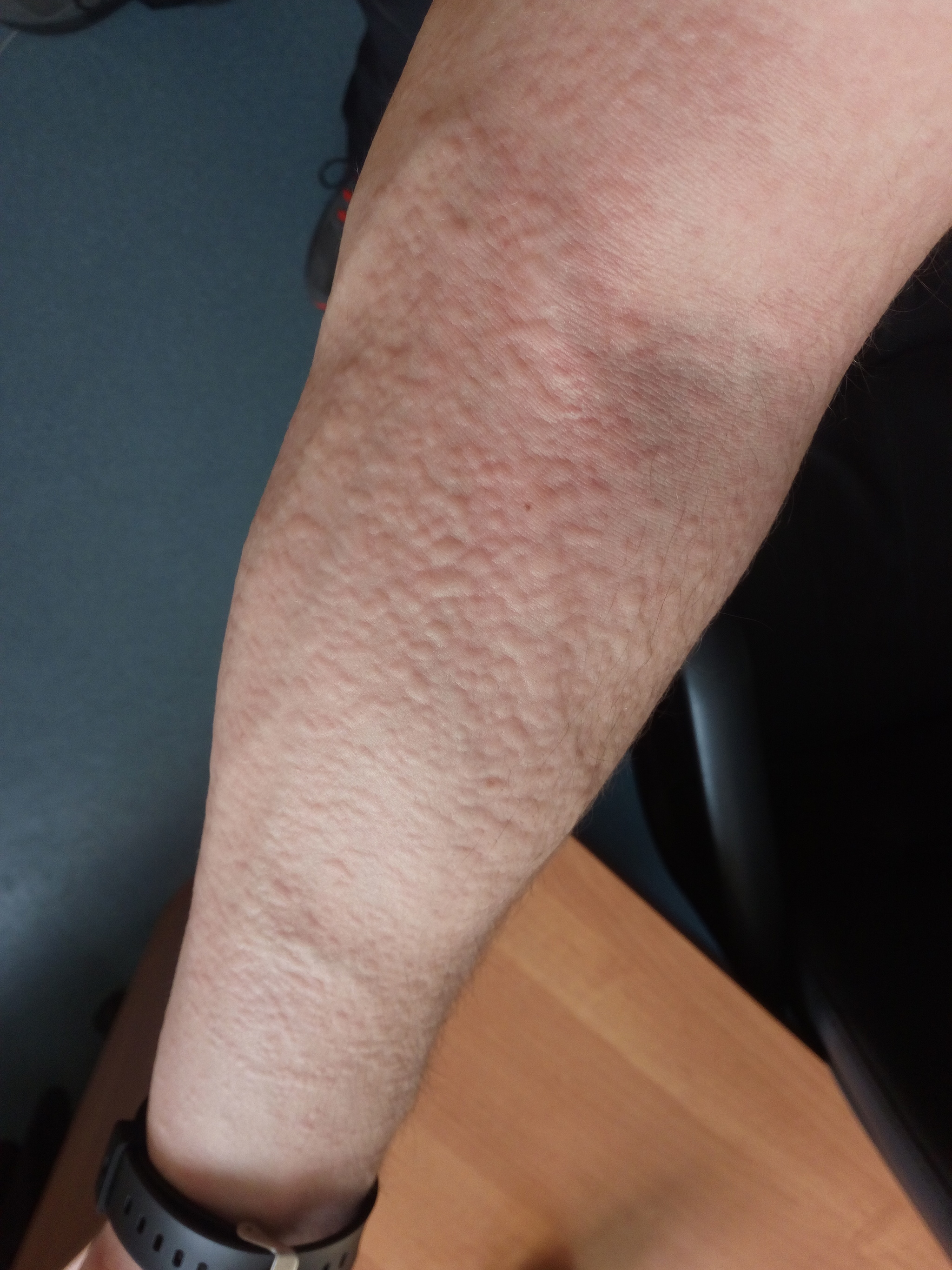 Help is needed - My, Dermatology, Allergies, Allergy, Longpost