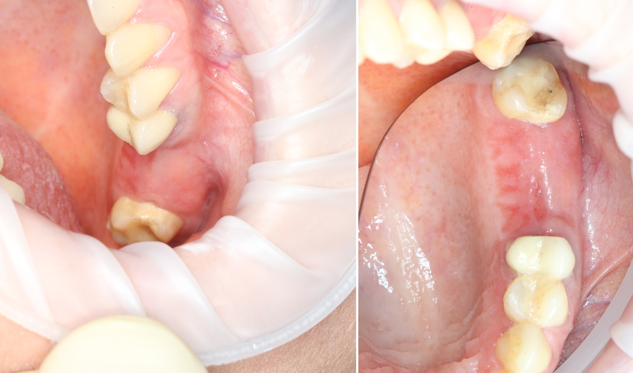 Sinus lift: how is it done? Part I - My, Dentist, Dentistry, Surgery, Implantation, Dental implantation, The medicine, Extraction of teeth, Doctors, Teeth, Doctor, Longpost, Informative