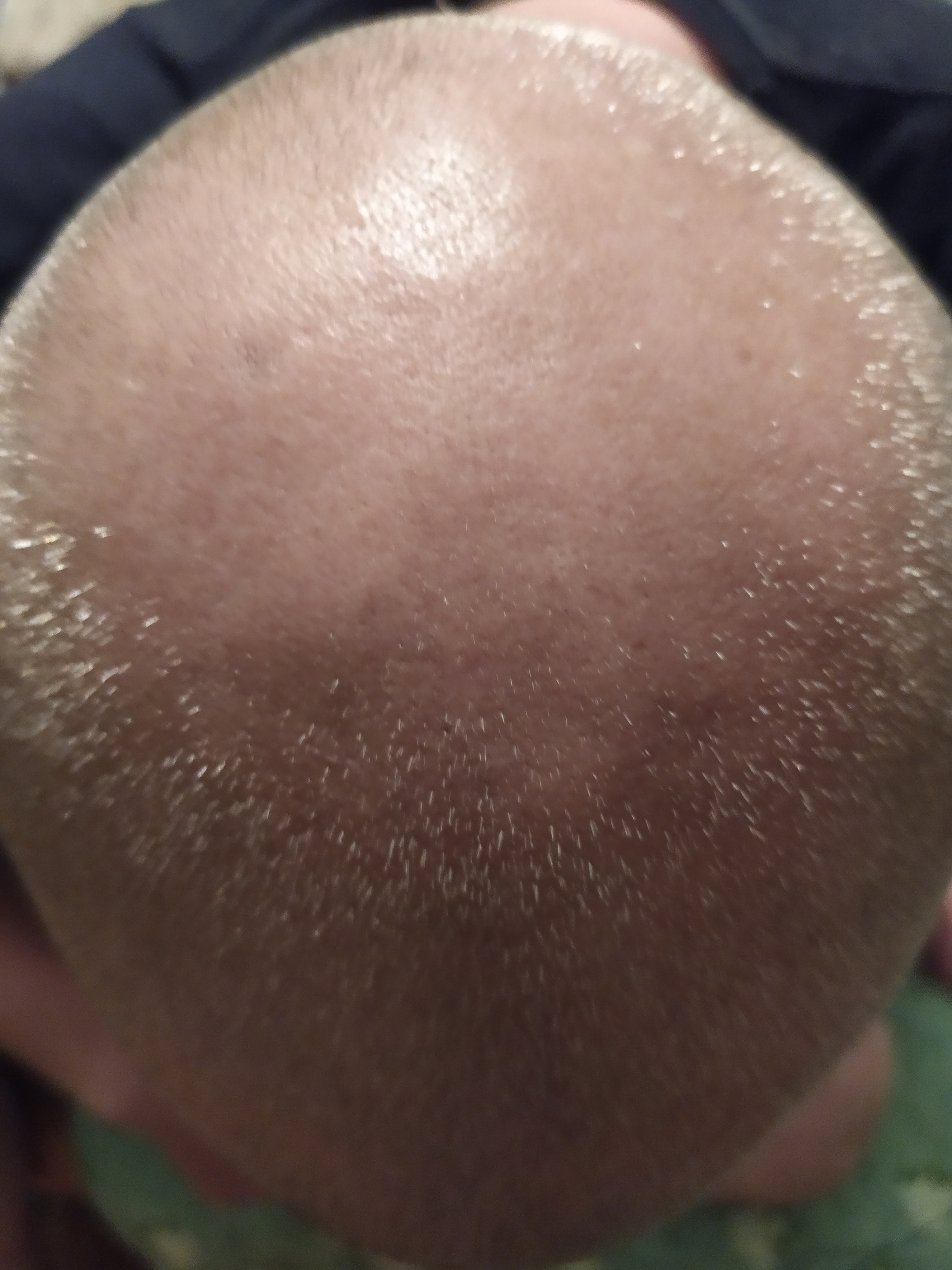 My way to treat baldness - Baldness, Treatment, Positive, Longpost