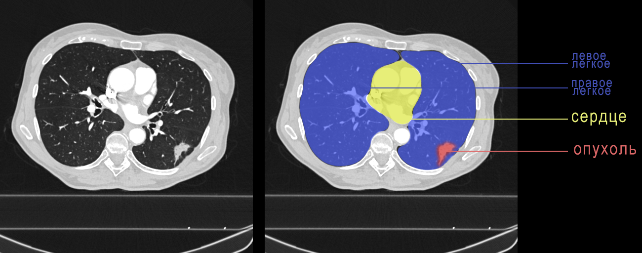 Puncture surgery or thoracoscopy in thoracic oncology - My, Cancer and oncology, Surgery, Longpost, GIF, The medicine