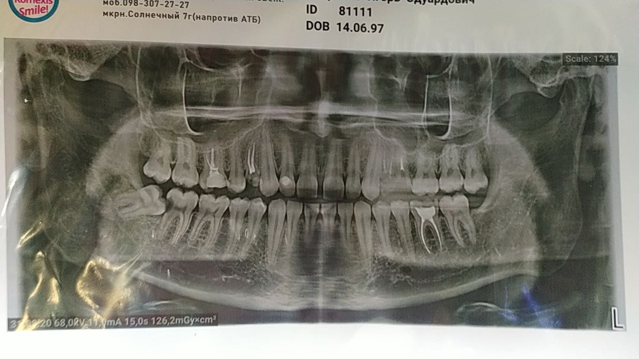 How wisdom teeth affect the ternary nerve - My, Wisdom tooth, Pain, Drugs, Longpost, Trigeminal nerve