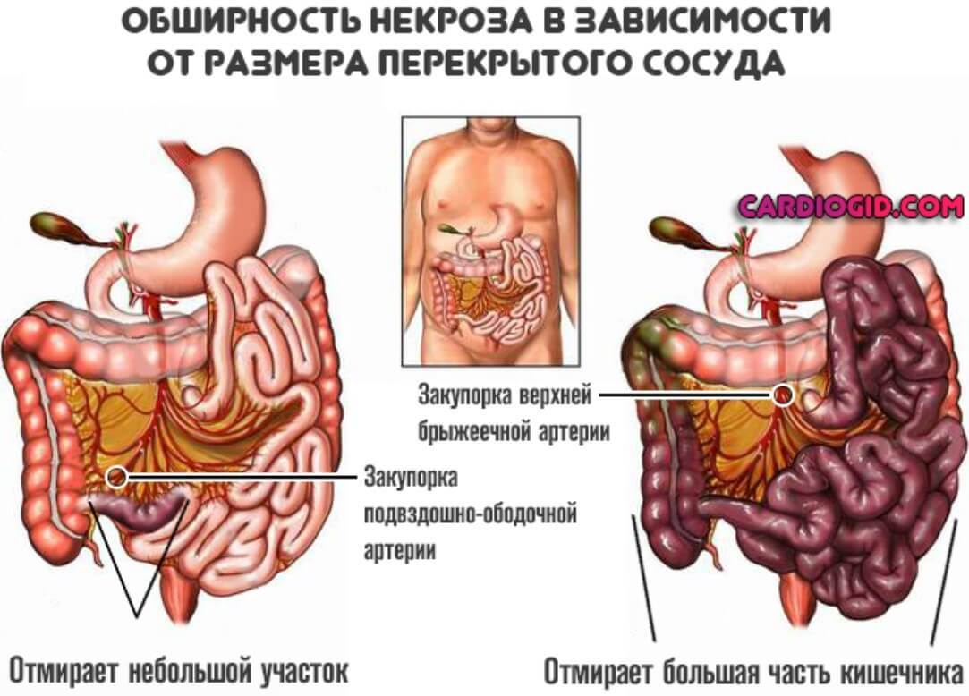 Болгарка - Моё, Медицина, Хирургия, Операция, Баллон, Болгарка, Картинки, Длиннопост