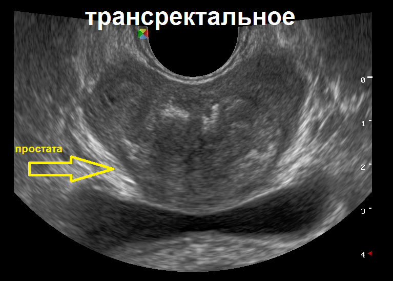 Digital rectal examination - Prostate, Urology, The medicine, Longpost