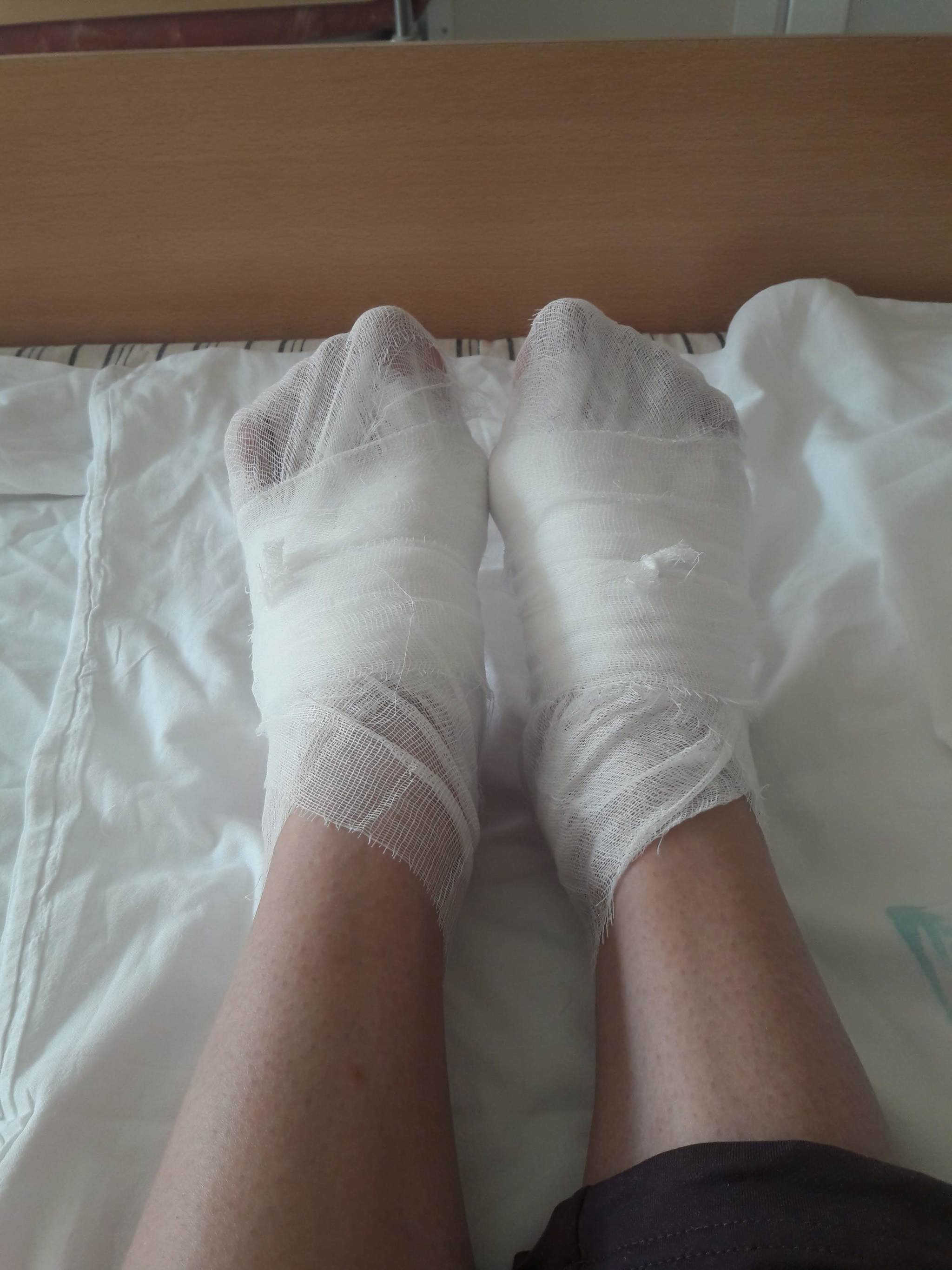 Hallux valgus or lousy bumps on the feet. History of surgical treatment and what happened in the end - My, Hallux valgus, Operation, The medicine, Legs, Longpost